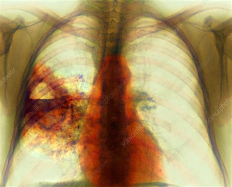 Lung Abscess X Ray Stock Image M1080613 Science Photo Library