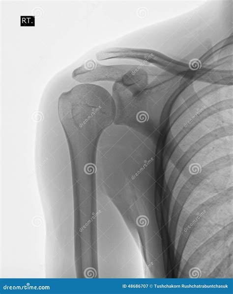 X Ray Of Human Shoulder Stock Image Image Of Healthcare 48686707