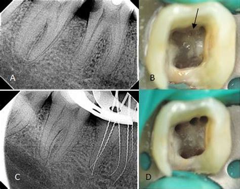 Mandibular First Molar With Six Root Canals A Rare Entity Bmj Case
