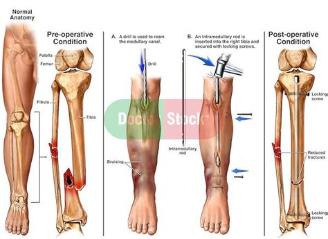 Before And After Broken Leg Broken Fibula Lower Leg Bones