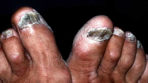 Nail Fungus Infection Causes And How To Get Rid Of Nail Fungus Infection
