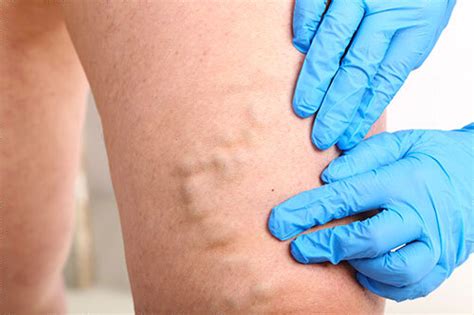 Early Stages Of Varicose Veins Symptoms — Physicians Vein Clinics