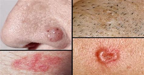 Natural And Alternative Ways To Flush Away Skin Cancer Just Naturally