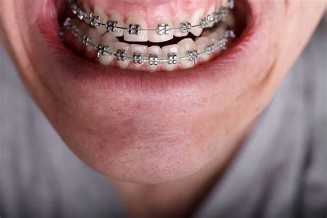 Mount Pleasant Orthodontist Adult Braces Invisalign Orthodontics
