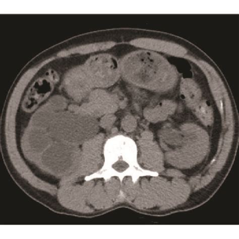 Ct Scan At The Time Of Admission Taken At The Level Of The Kidneys