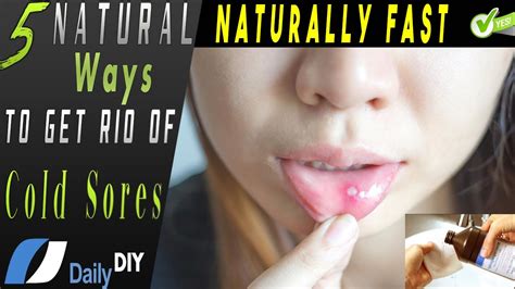 How To Get Rid Of Cold Sore Naturally Fast Cold Sore Remedies