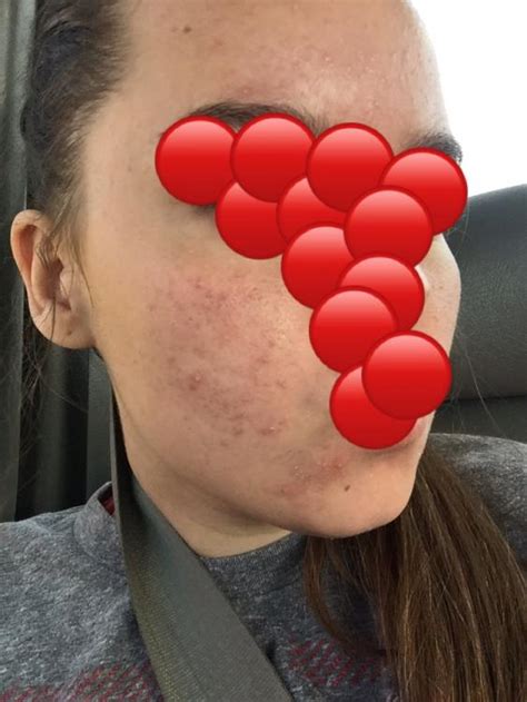 Hyperpigmentation Scars Hyperpigmentation Reddark Marks Acne