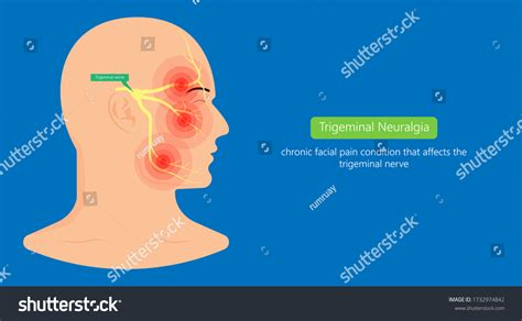 Trigeminal Neuralgia Chronic Pain Facial Tmd Stock Vector Royalty Free
