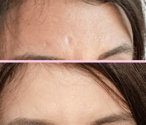31 Microneedling For Acne Scars Before And After Pictures Images Just Sharing