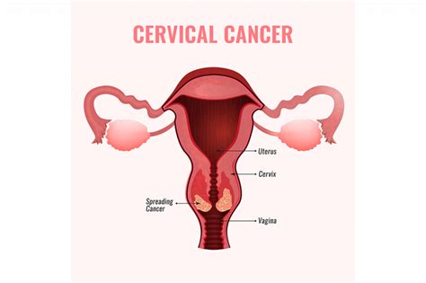 Dont Delay—get Screened And Protect Yourself Against Cervical Cancer