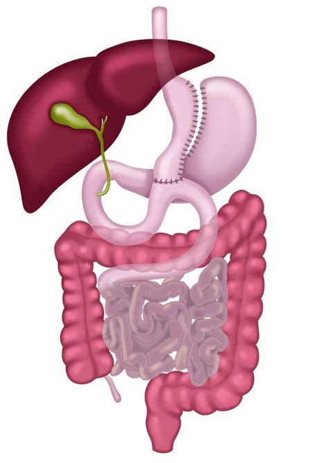 Everyhing About Mini Gastric Bypass Surgery Op Dr Murat Üstün