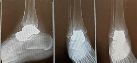 Orthopedic Foot And Ankle Surgeon Performs 3d Total Talus Replacement