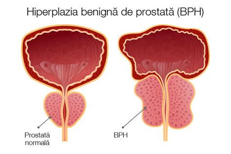 Hiperplazia Benigna De Prostata Hbp Semne Simptome Cauze Factori