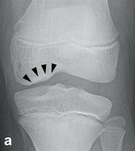 A Radiograph Of The Left Knee Showing Brückls Stage Iii Ocd Lesion