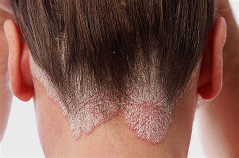 What Causes Seborrheic Dermatitis Face