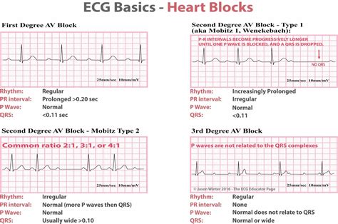 Ekg Heart Rate Blocks