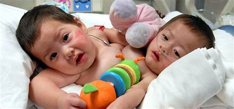 Conjoined Twins Separated by Surgeons - The New York Times