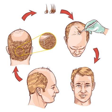 Fue Hair Transplant The Bombay Skin Clinic