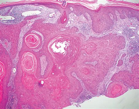 Ulcerated Nodule On The Scalp Mdedge Dermatology