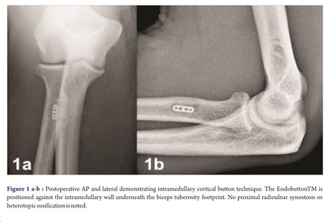 Icd 10 Code For Subluxation Biceps Tendon