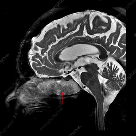 Inverted Papilloma Mri Stock Image C Science Photo Library