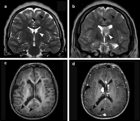 Characteristic Mri Findings In Tsc A Foci Of T2 Hyperintensity In The