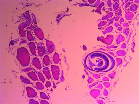 Cysts Of Trichinella Spiralis Low Power View Download Scientific