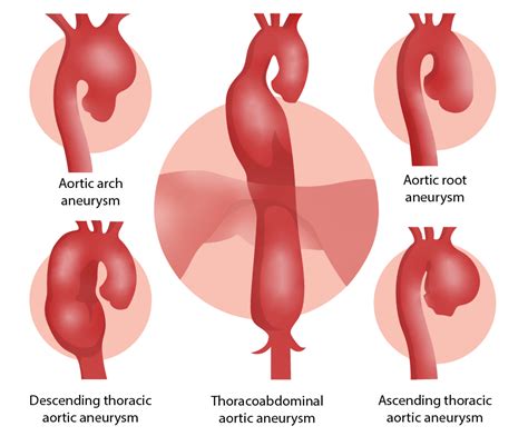 Thoracic Aortic Aneurysms Concise Medical Knowledge