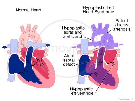 Hypoplastic Left Heart Syndrome