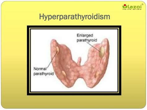 Diagnosis Of Hyperparathyroidism