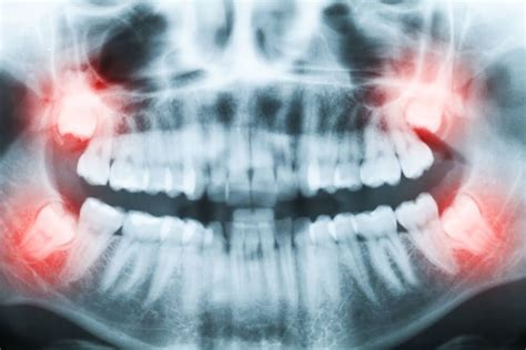 Wisdom Teeth Removal Complete Bony Impacted 3d Dentistry Bradenton Fl