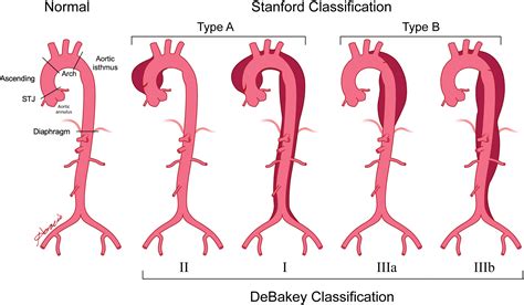 Aortic Dissection And Other Acute Aortic Syndromes Diagnostic Imaging