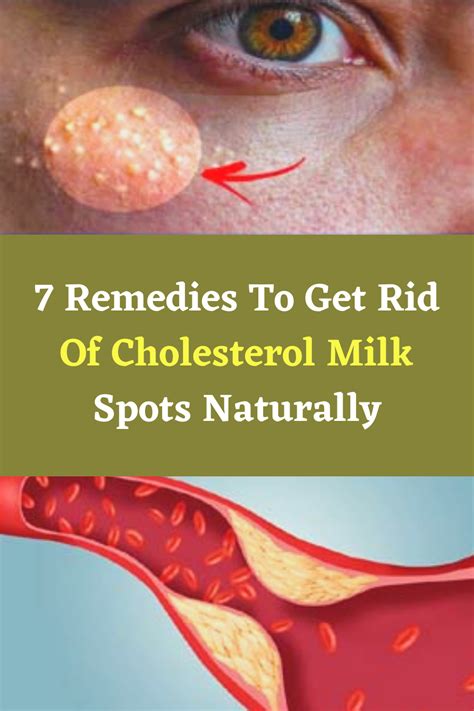 7 Remedies To Get Rid Of Cholesterol Milk Spots Naturally