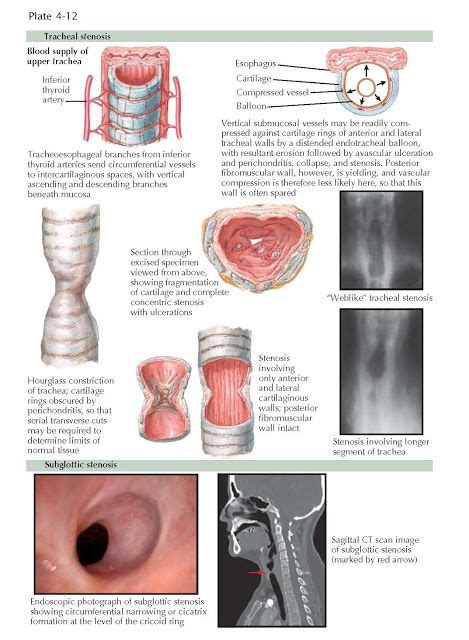 Laryngeal And Tracheal Stenosis Tracheal Stenosis Stenosis Avascular