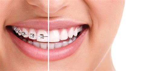 Orthodontic Retention Biermann Orthodontics