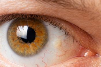 Mancha amarilla en el ojo abultada Qué es causas y tratamiento