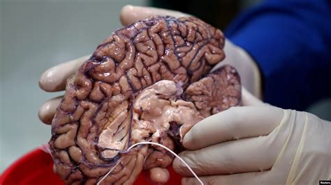 Must be love on the brain yeah. The Human Brain in it's Maximum Beauty and Complexity
