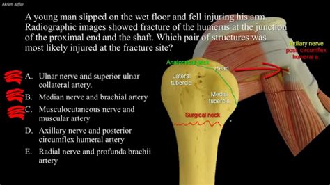 Fractures Of The Humeurs And Possible Nerve Injuries Youtube