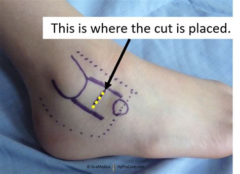 Placement Of Hyprocure Hyprocure The Proven Solution To Misaligned Feet
