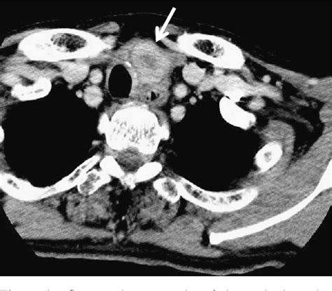Figure 1 From A Case Of Metastasis To The Anterior Mediastinum From