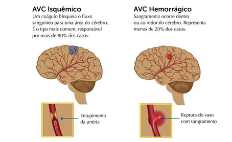 Doen As Cerebrovasculares Avc Dr Alan Chester Neurologia Geral
