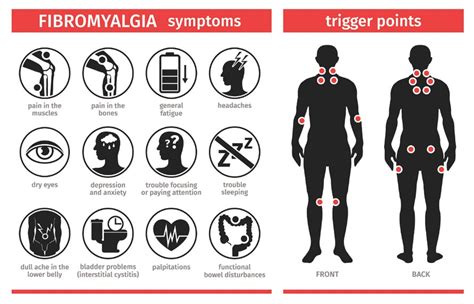 Fibromyalgia Trigger Point Chart