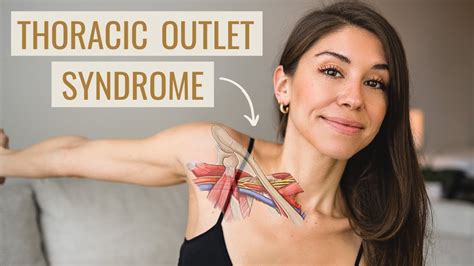 Thoracic Outlet Syndrome Exercises How To Fix It Causes Symptoms Treatment Youtube