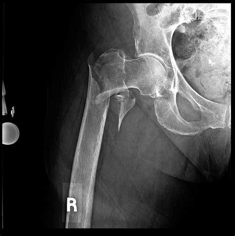 Complete Comminuted Intertrochanteric Fracture Of The Right Hip Case