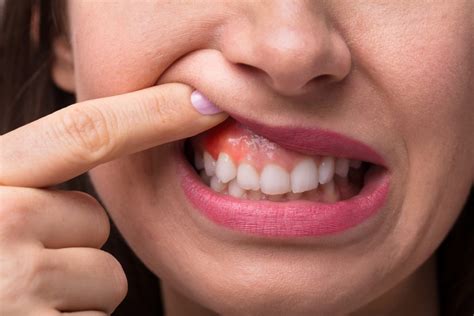 Houston Dentist Explains Why Sore Gums Could Mean You Need A Deep
