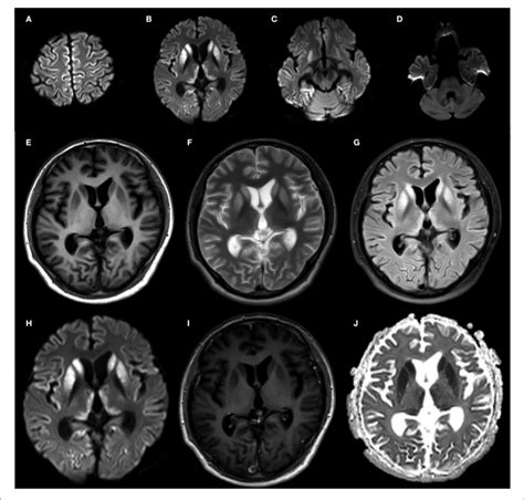 Brain Mri Of The Proband At 20 Months After Onset A D Dwi