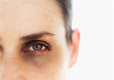 The Truth About Dark Circles Causes And Links To Diseases