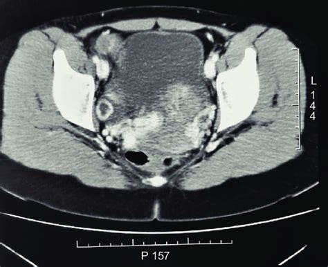 ct scan shows a uterus with slightly increased volume with innumerable download scientific
