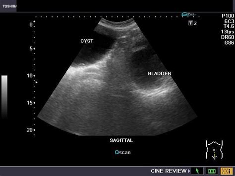 The Above Transabdominal Ultrasound Images Show A Huge Serous