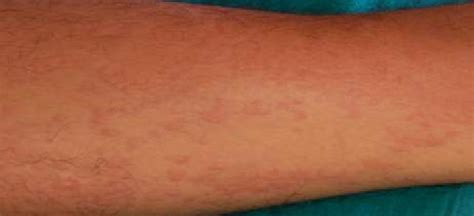 Maculopapular Rashes On Arm Of Both Upper Limbs Download Scientific